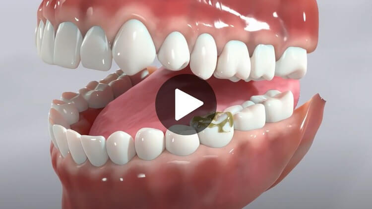 Thumbnail image for educational video on cavities