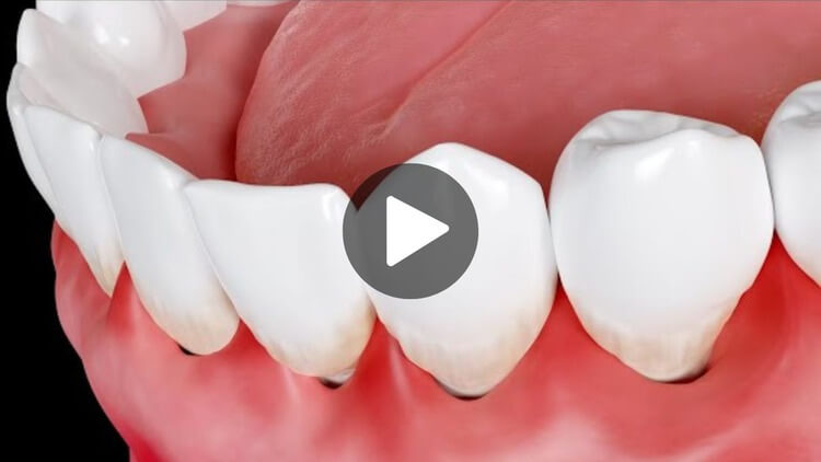 Thumbnail image for educational video on swollen gums